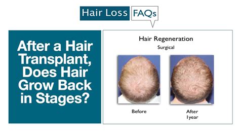 Learn about encouraging hair growth following a hair transplant. After a Hair Transplant, Does Hair Grow Back in Stages ...