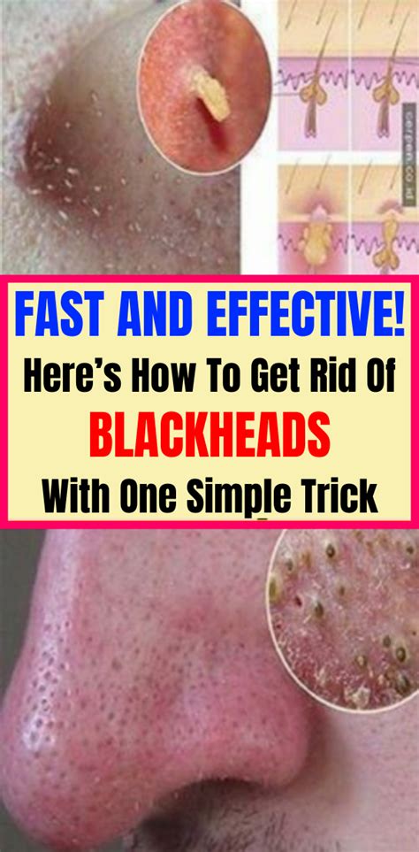 Fast And Effective Heres How To Get Rid Of Blackheads With One Simple