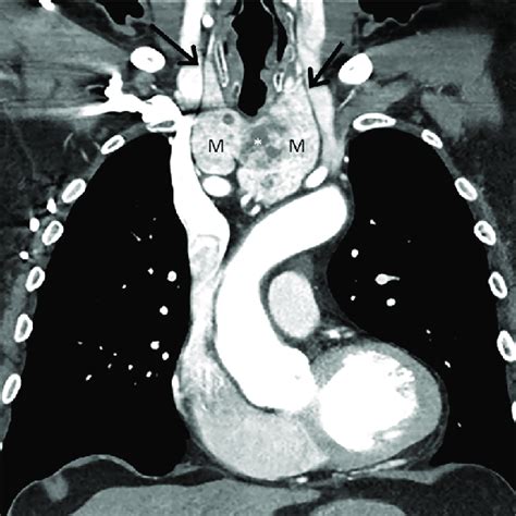 Thyroid Goiter Contrast Enhanced Coronal Ct Of A 67 Year Old Woman