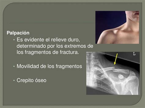 Tratamiento Quirurgico Fractura Y Pseudoartrosis De Clavicula Images