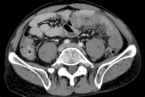 Abdominal Computed Tomography Finding It Shows Diffuse Wall Thickening