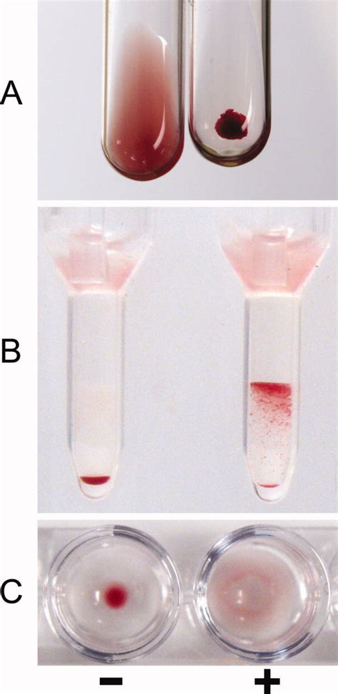 Direct antiglobulin test (dat) and indirect antiglobulin test. The direct antiglobulin test: A critical step in the ...