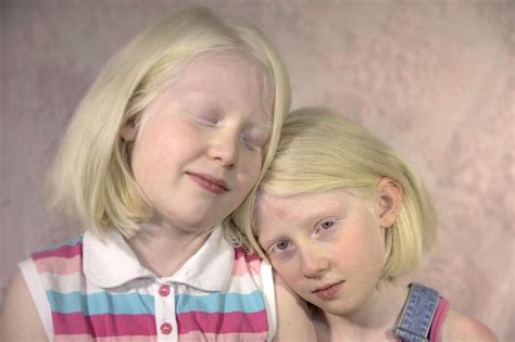 Albinizm Nedir BilimUP