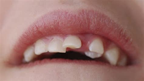Dental Intrusion Archives Small Bites