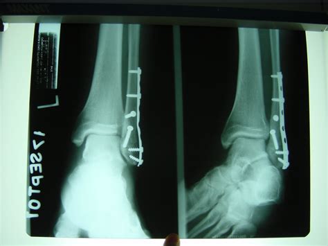 New choice health educates and protects consumers from overpaying for medical procedures. X-Ray's of broken fibula