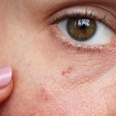 Laser Treatment For Broken Blood Vessels On The Face