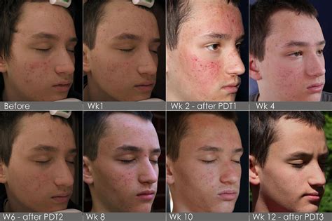Dermatologist Before And After Acne