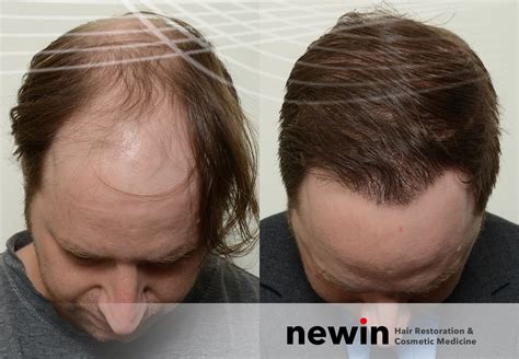 Stem Cell Hair Restoration What You Need To Know In 2023 ~ All About