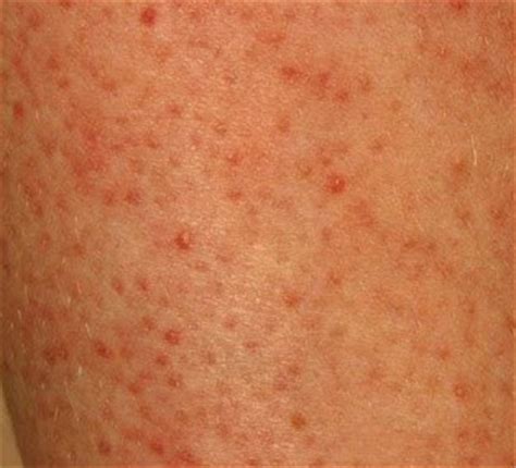 They are dome shaped bumps that occur on the skin and do not itch. Small Red Spots on Skin, Itchy, Tiny, Dots, Bumps ...