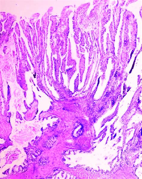 İntracystic Papillary Neoplasm With Invasive Carcinoma Hand X400