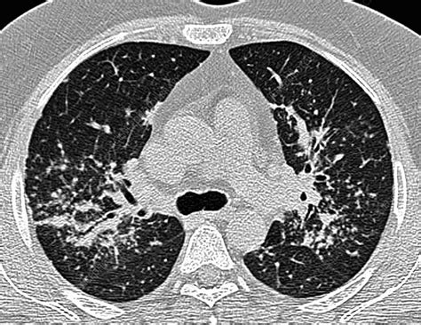 Interstitial Pneumonia In Sarcoidosis Lung Ct Scan Stock Image