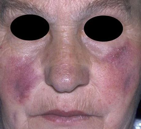 Lupus pernio is a chronic raised indurated (hardened) lesion of the skin, often purplish in color. Sarcoidosis Official Website