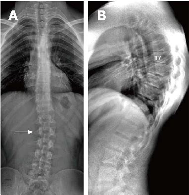 Familial scheuermann disease is characterized by kyphotic deformity of the spine that develops in adolescence. Figure 10 from Radiological imaging findings of ...