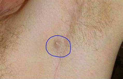 A different method may be needed to get rid of hair in that area. Ingrown Armpit Hair, Lymph Node, Pictures, Lump, How to ...