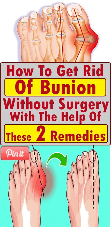 How To Get Rid Of Bunion Without Surgery With The Help Of These 2
