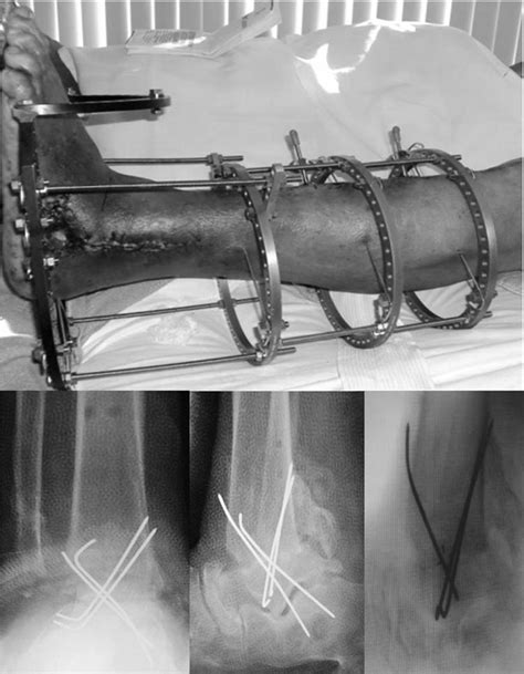 Diabetic Limb Salvage In The Septic Ankle Case Studies Of Arthrodesis