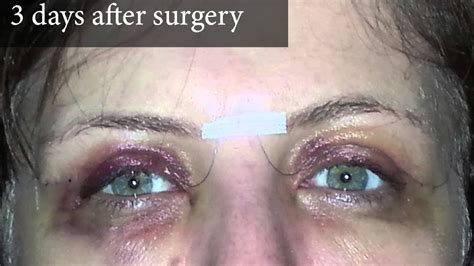 upper eyelid surgery photos of a real patient and video account of three days after surgery