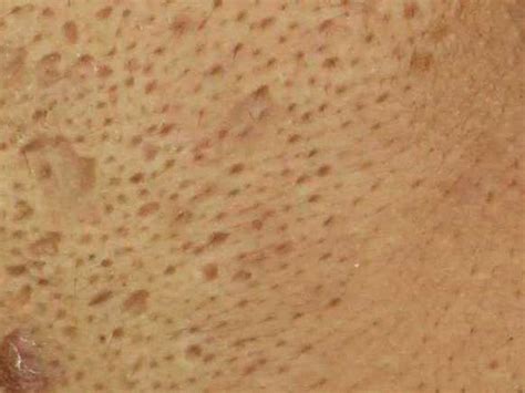 Acne Scar Treatment Ozhean