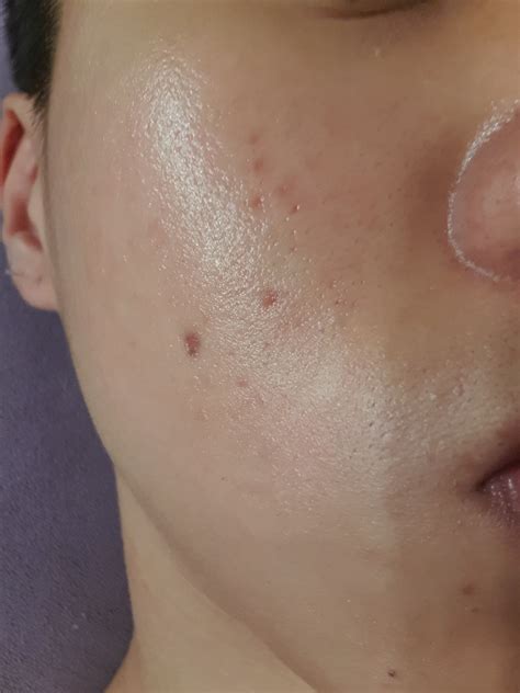What Combination Acne Scar Treatment Is Best For Red And Pitted Acne