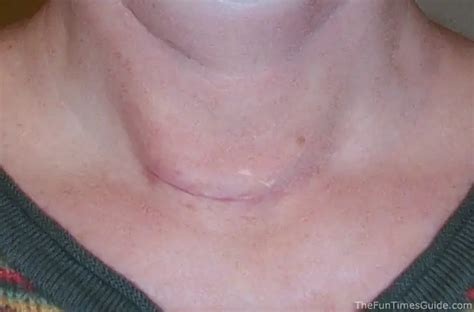 Thyroid Surgery Recovery Photos And Progress Reports The Health Guide