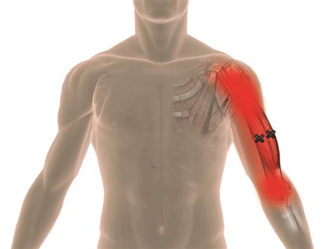 Arm Trigger Points