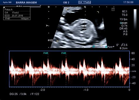 Batimentos Cardíacos Fetais 167 Bpm