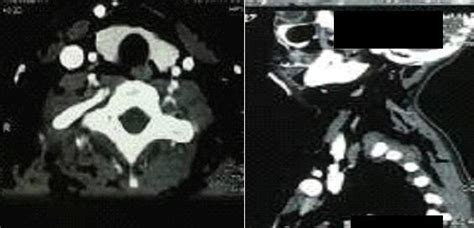 Ct Neck Demonstrating Tracheal Discontinuity At Cervical And Thoracic