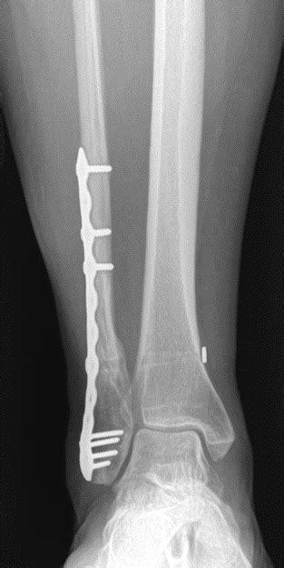 Ankle Fracture John Riehl Md