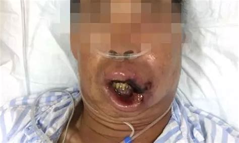 There are kiesselbach plexus at the anteroinferior septum of nose. Man in China nearly dies after popping 'pimple' in 'danger ...