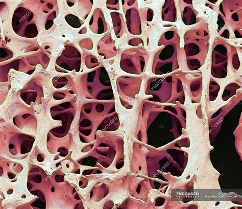 Coloured Scanning Electron Micrograph Of Human Cancellous Spongy Bone