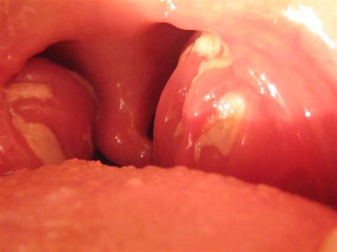 Swollen Tonsils Causes Picture Symptoms And Treatment