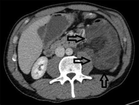 Abdomen Ct Scan Shows A “cluster” Of Jejunal Loops In The Left Upper