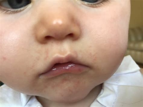 Baby Rash Around Mouth And Nose Get More Anythinks