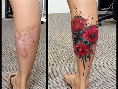 Top 100 Tattoo Over Scars Pictures