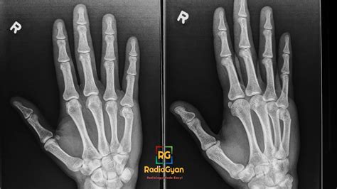 Boxers Fracture Why Is It A Misnomer Radiology Case Radiogyan