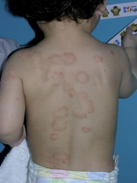 Annular Erythema And Papules In Infantile Atopic Dermatitis Html