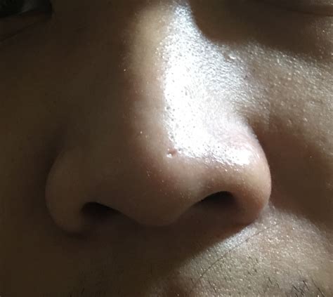 Deep Acne Scar In Nose Tip Scar Treatments