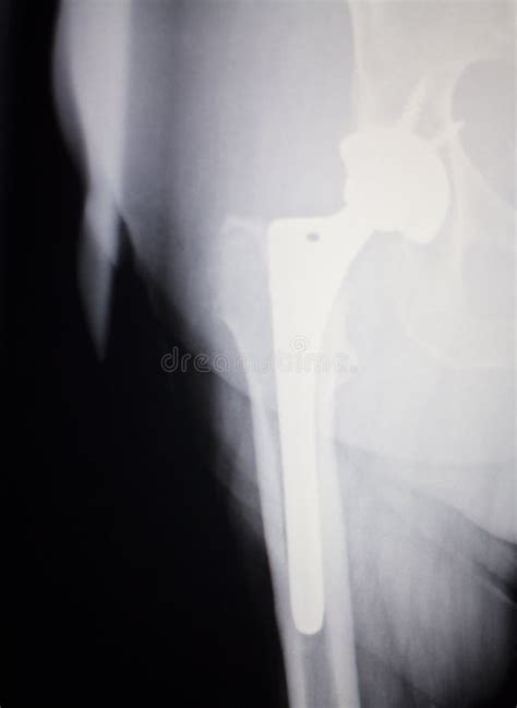 Hip Joint Replacement Xray Stock Photo Image Of Orthopedic 85287346