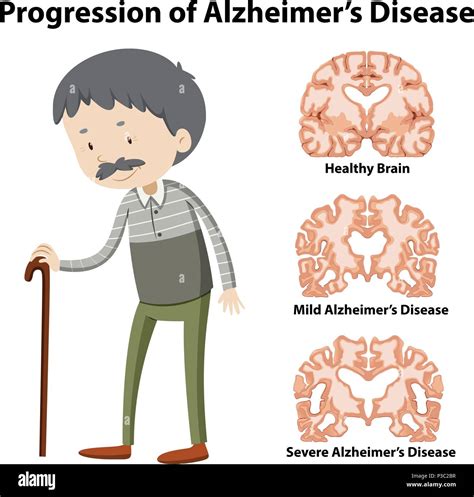 Progression Of Alzheimers Disease Illustration Stock Vector Image