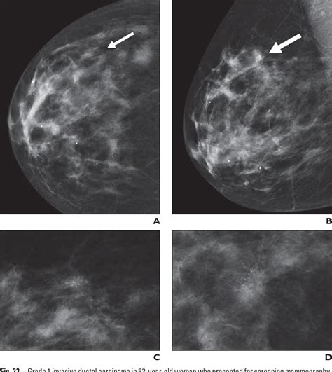 Figure 2 From Breast Calcifications The Focal Group Semantic Scholar