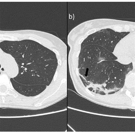 A Ct Scan Shows Focal Consolidation In The Subpleural Area Of The