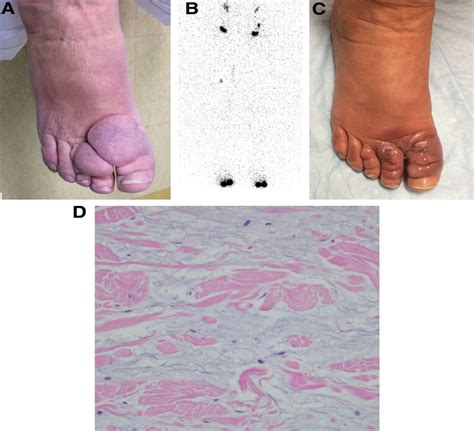 Nodular Foot Myxedema Masquerading As Lymphedema Plastic And