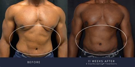 Does Coolsculpting® Work For Men Everything You Need To Know