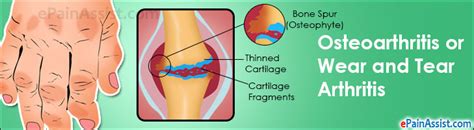 Osteoarthritis Or Wear And Tear Arthritistypescausessymptoms