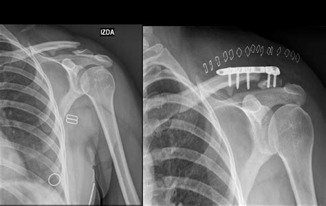 1150 Indicaciones De Tratamiento QuirÚrgico En Fracturas De ClavÍcula
