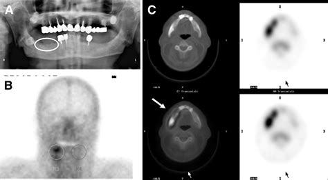 Bone Scintigraphy And Spectct Of Bisphosphonate Induced Osteonecrosis