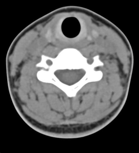 Normal Cervical Spine Ct Radiology Case