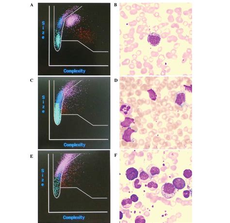 Immature Granulocytes Causes Absolute And Normal Range