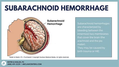 Subarachnoid Hemorrhage In Newborns Reiter And Walsh