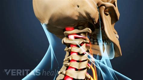 How Cervical Radiculopathy Causes Pain Numbness And Weakness